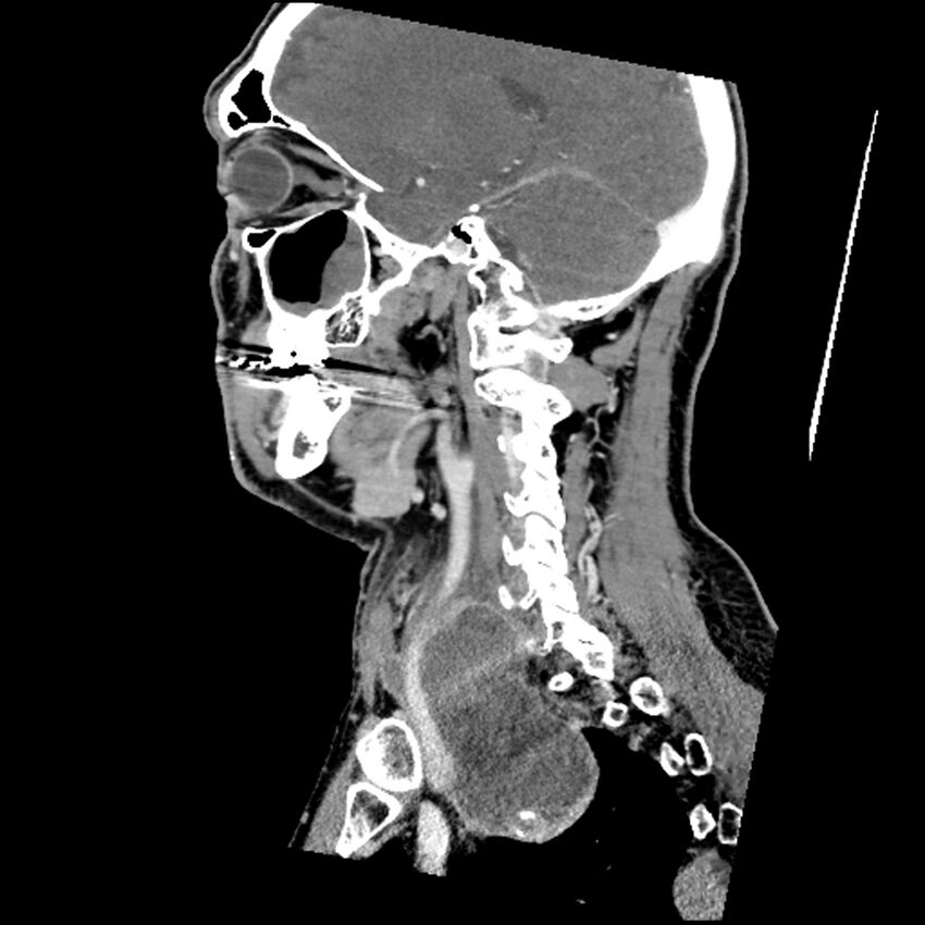 Anaplastic thyroid carcinoma (Radiopaedia 79087-92034 C 36).jpg
