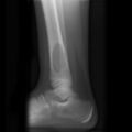 Aneurysmal bone cyst (Radiopaedia 7495-8321 Lateral 1).jpg