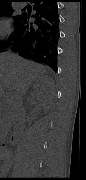 File:Aneurysmal bone cyst T11 (Radiopaedia 29294-29721 Sagittal bone window 66).jpg