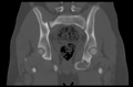 Aneurysmal bone cyst of ischium (Radiopaedia 25957-26094 Coronal bone window 26).png