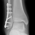 Ankle fracture - Weber B (Radiopaedia 2742-29593 Oblique 1).jpg