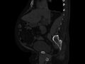 Ankylosing spondylitis (Radiopaedia 44609-48357 Sagittal bone window 42).jpg