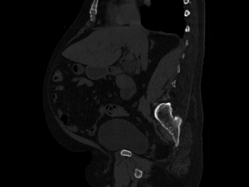 File:Ankylosing spondylitis (Radiopaedia 44609-48357 Sagittal bone window 42).jpg