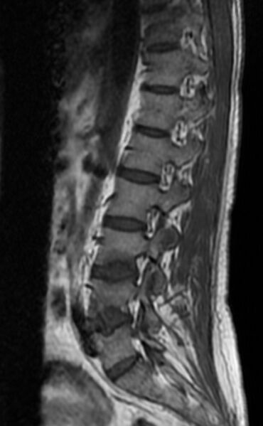 File:Ankylosing spondylitis - Andersson lesion (Radiopaedia 81878-95838 Sagittal T1 9).jpg