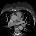 Anomalous origin of left circumflex artery from right coronary sinus (Radiopaedia 72563-83117 A 49).jpg