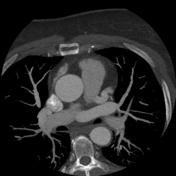 File:Anomalous origin of left circumflex artery from right coronary sinus (Radiopaedia 72563-83117 A 49).jpg