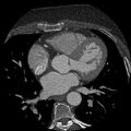 Anomalous origin of left circumflex artery from right coronary sinus (Radiopaedia 72563-83117 B 67).jpg