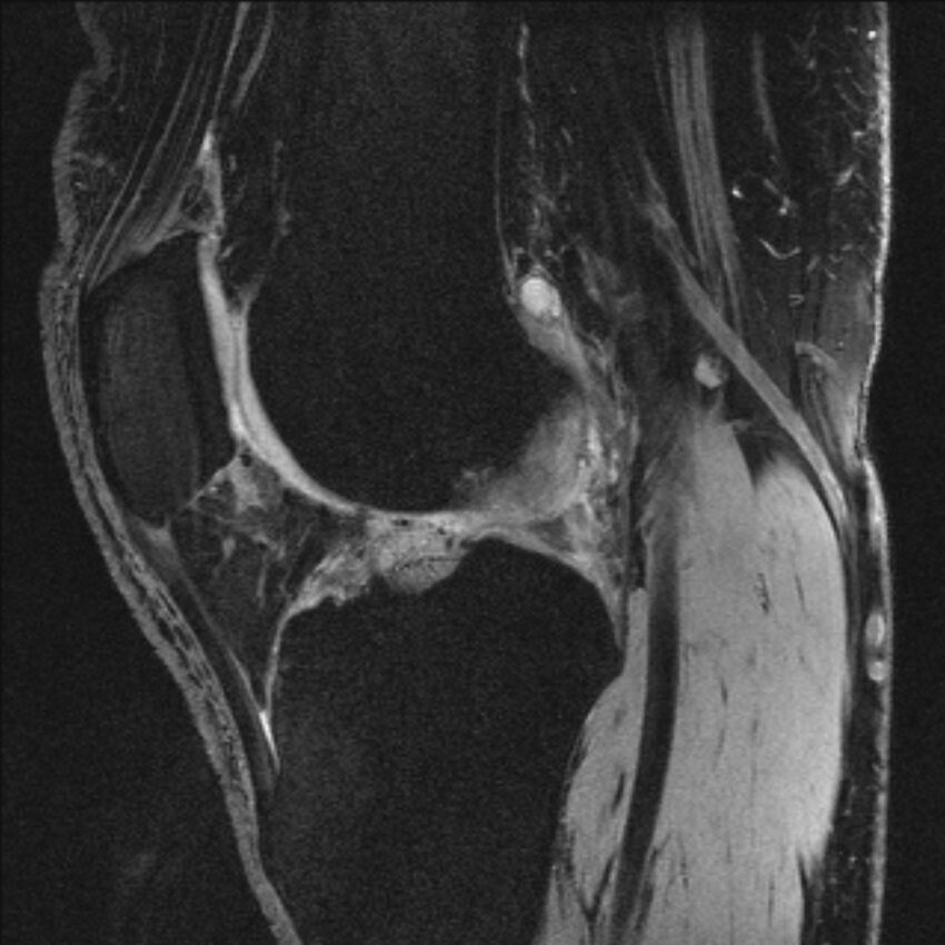 Anterior cruciate ligament mucoid degeneration (Radiopaedia 68400-77933 Sagittal 27).jpg