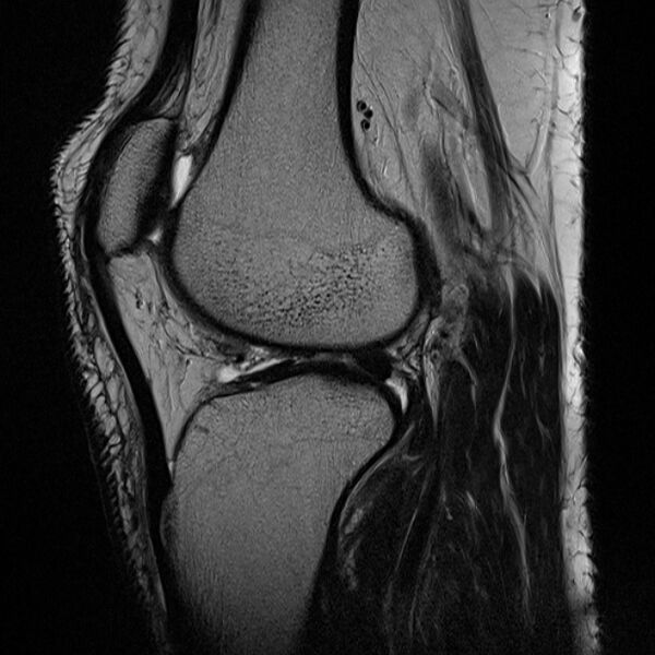 File:Anterior cruciate ligament tear - ramp lesion (Radiopaedia 71883-82322 Sagittal T2 10).jpg