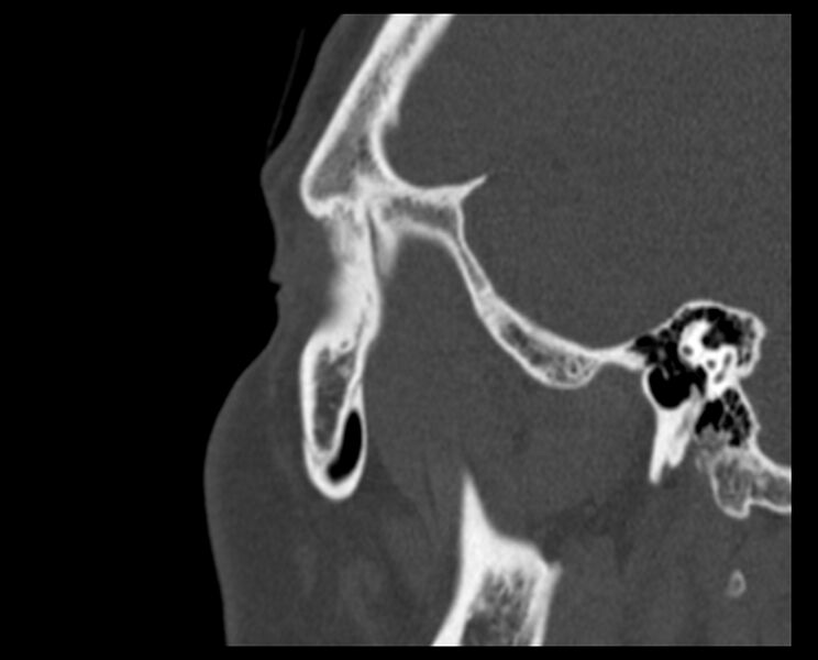 File:Antrochoanal polyp (Radiopaedia 21894-21868 Sagittal bone window 40).jpg