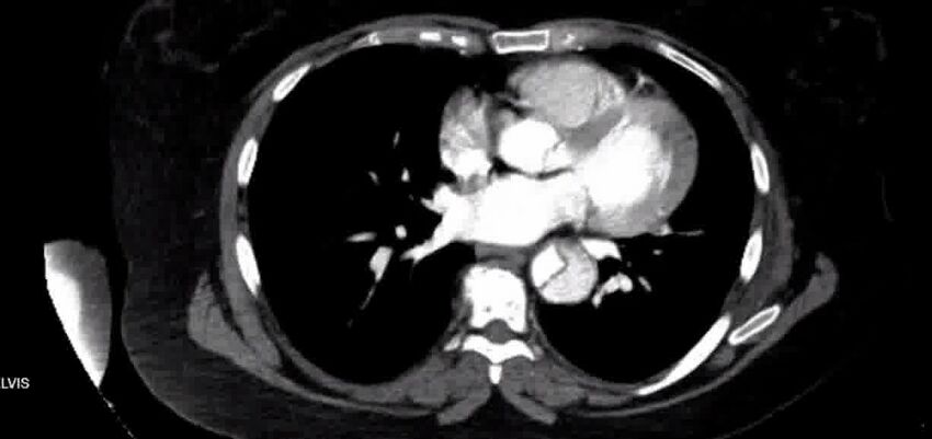 Aortic Dissection (Radiopaedia 85272-100847 A 27).jpg