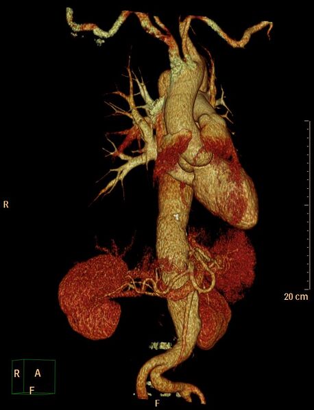 File:Aortic aneurysm and penetrating ulcer (Radiopaedia 23590-23704 3D reconstruction 3).jpg