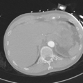 Aortic dissection - DeBakey type II (Radiopaedia 64302-73082 Axial lung window 58).png