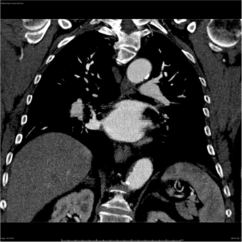 Aortic dissection - Stanford type A (Radiopaedia 26183-26315 A 42).jpg