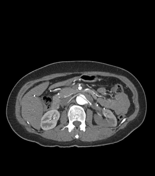 File:Aortic dissection with renal ischemia (Radiopaedia 76573-88338 A 69).jpg