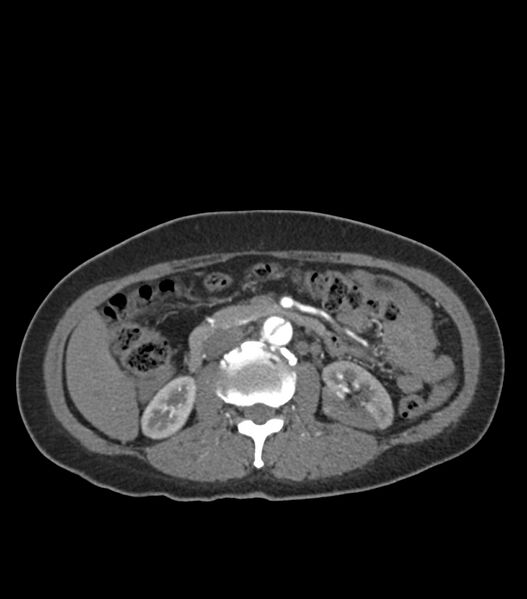 File:Aortic dissection with renal ischemia (Radiopaedia 76573-88338 A 74).jpg