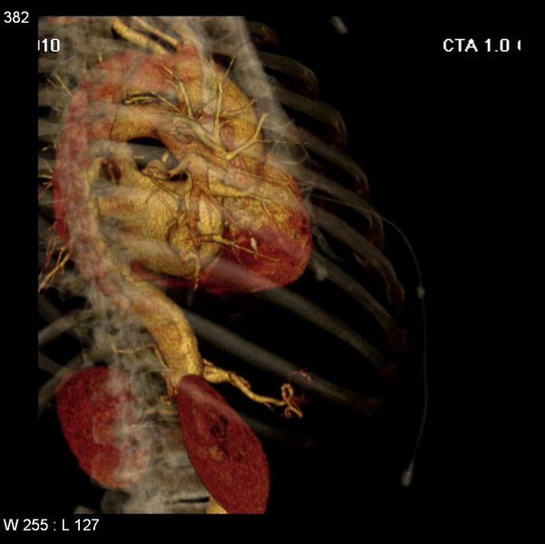 File:Aortic dissection with rupture into pericardium (Radiopaedia 12384-12647 C+ arterial phase 14).jpg