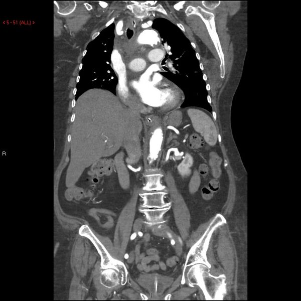 File:Aortic intramural hematoma (Radiopaedia 27746-28001 B 28).jpg