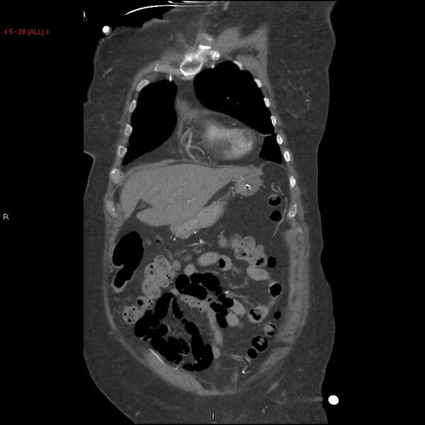 File:Aortic intramural hematoma (Radiopaedia 27746-28001 B 5).jpg