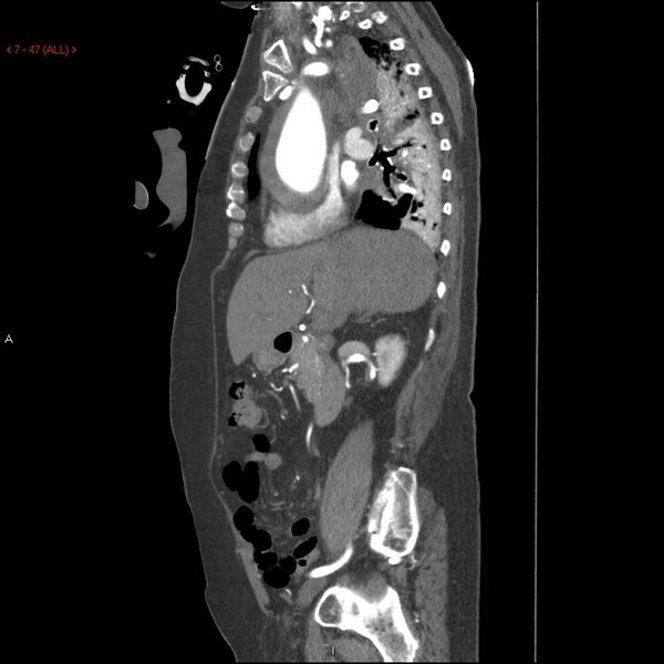 File:Aortic intramural hematoma (Radiopaedia 27746-28001 C 16).jpg