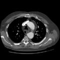 Aorto-coronary bypass graft aneurysms (Radiopaedia 40562-43157 A 34).png