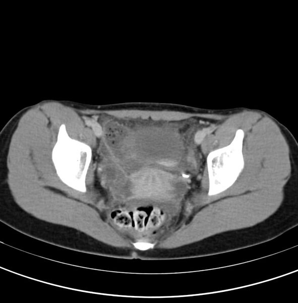 File:Appendicitis and incidental bicornuate uterus (Radiopaedia 22833-22853 Axial C+ delayed 36).jpg