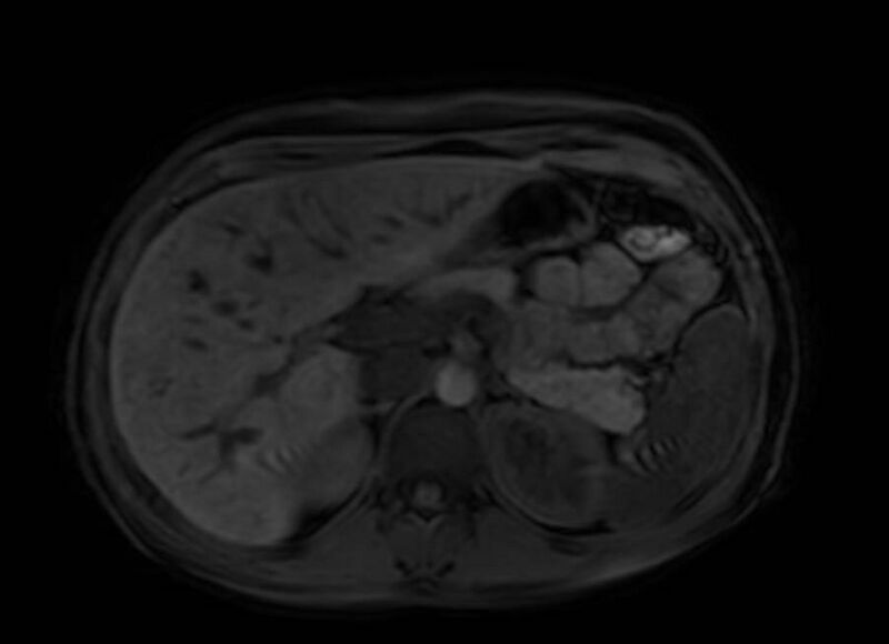 File:Appendicitis in gravida (MRI) (Radiopaedia 89433-106395 Axial DIXON 31).jpg