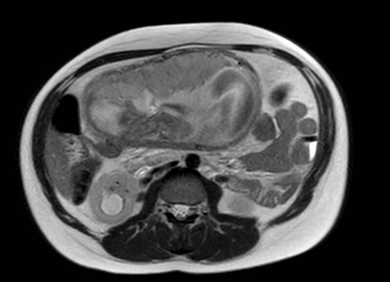File:Appendicitis in gravida (MRI) (Radiopaedia 89433-106395 Axial T2 30).jpg