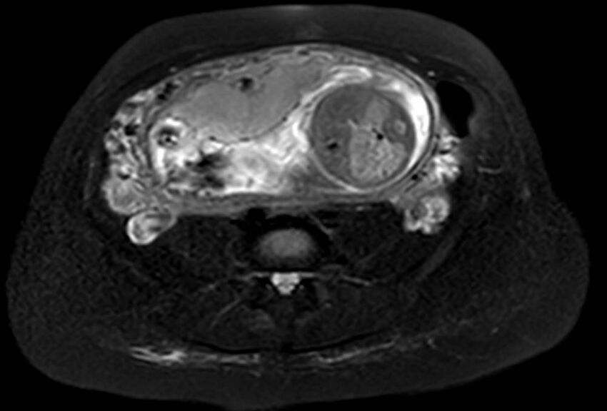 Appendicitis in gravida (MRI) (Radiopaedia 89433-106395 Axial T2 SPAIR 49).jpg