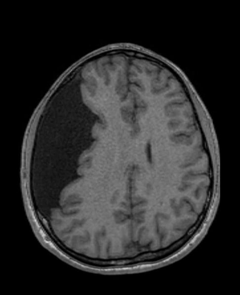 File:Arachnoid cyst- extremely large (Radiopaedia 68741-78451 Axial T1 51).jpg