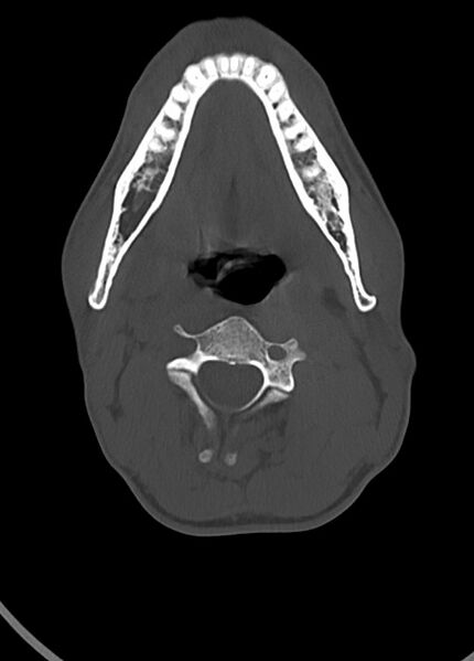 File:Arrow injury to the head (Radiopaedia 75266-86388 Axial bone window 21).jpg