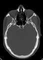 Arrow injury to the head (Radiopaedia 75266-86388 Axial bone window 59).jpg