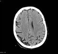 Arteriovenous malformation - cerebral (Radiopaedia 8172-9020 Axial non-contrast 16).jpg