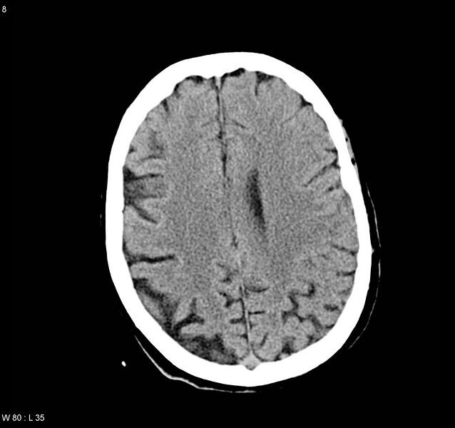 File:Arteriovenous malformation - cerebral (Radiopaedia 8172-9020 Axial non-contrast 16).jpg