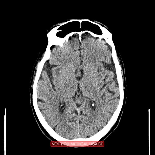 File:Artery of Percheron infarction (Radiopaedia 28679-28967 Axial non-contrast 61).jpg
