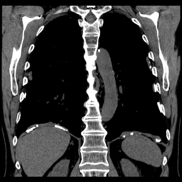 File:Asbestos-related pleural plaques (Radiopaedia 39069-41255 Coronal non-contrast 27).jpg