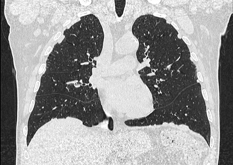 File:Asbestos pleural placques (Radiopaedia 57905-64872 Coronal lung window 130).jpg