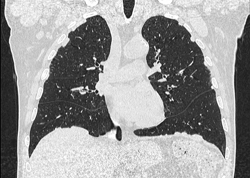 Asbestos pleural placques (Radiopaedia 57905-64872 Coronal lung window 130).jpg