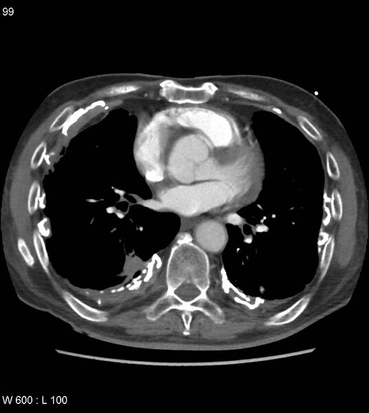 File:Asbestos related lung and pleural disease (Radiopaedia 14377-14301 D 35).jpg