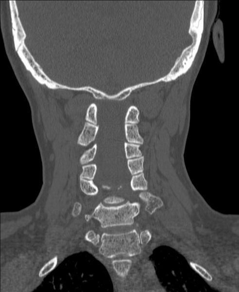 File:Atlanto-occipital assimilation with basilar invagination (Radiopaedia 70122-80188 Coronal bone window 138).jpg