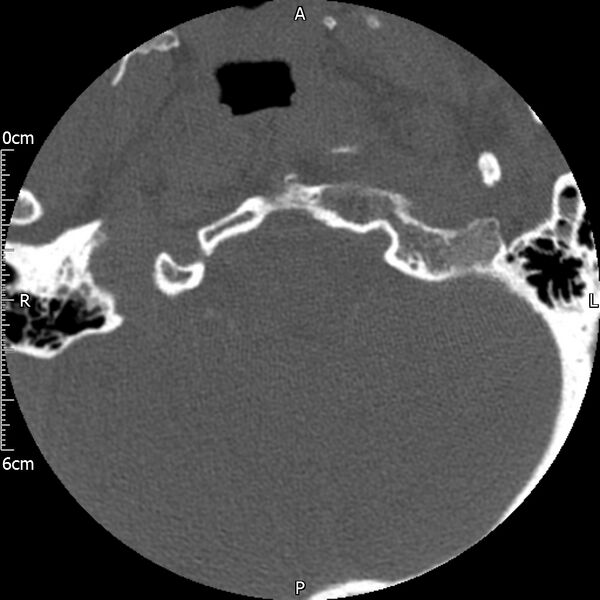 File:Atlas fracture with Currarino type A congenital defect (Radiopaedia 71747-82144 Axial bone window 7).jpg