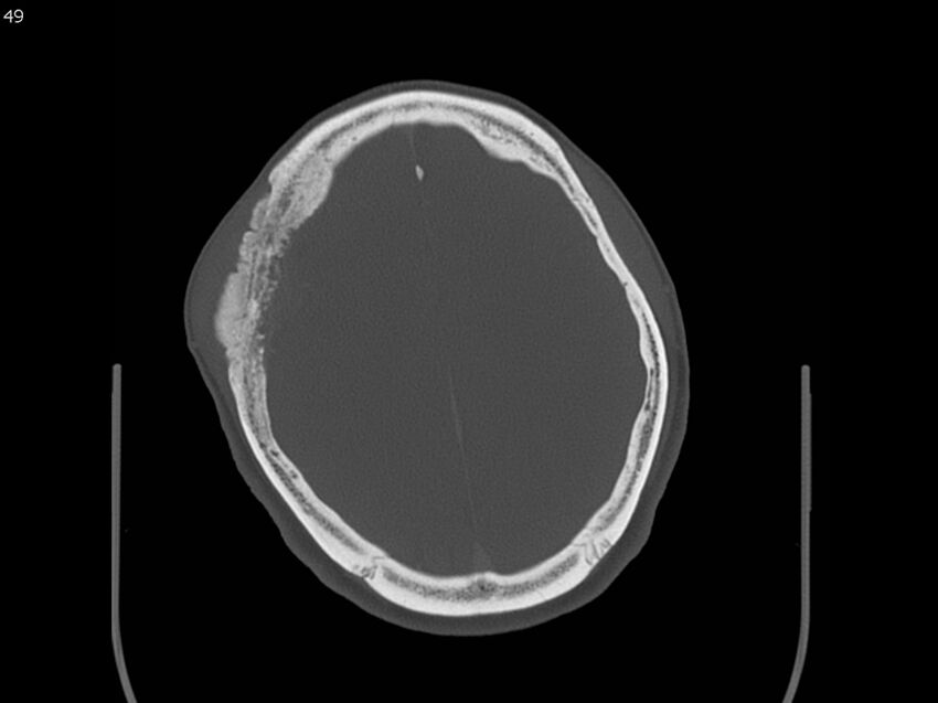 Atypical meningioma - intraosseous (Radiopaedia 64915-73867 Axial C+ bone window 49).jpg
