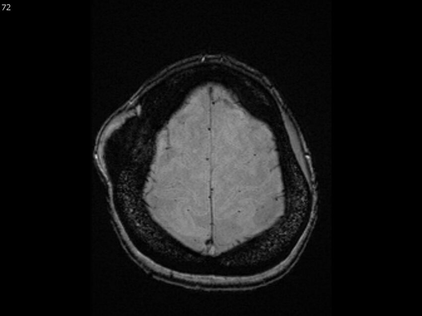 Atypical meningioma - intraosseous (Radiopaedia 64915-74572 Axial SWI 72).jpg