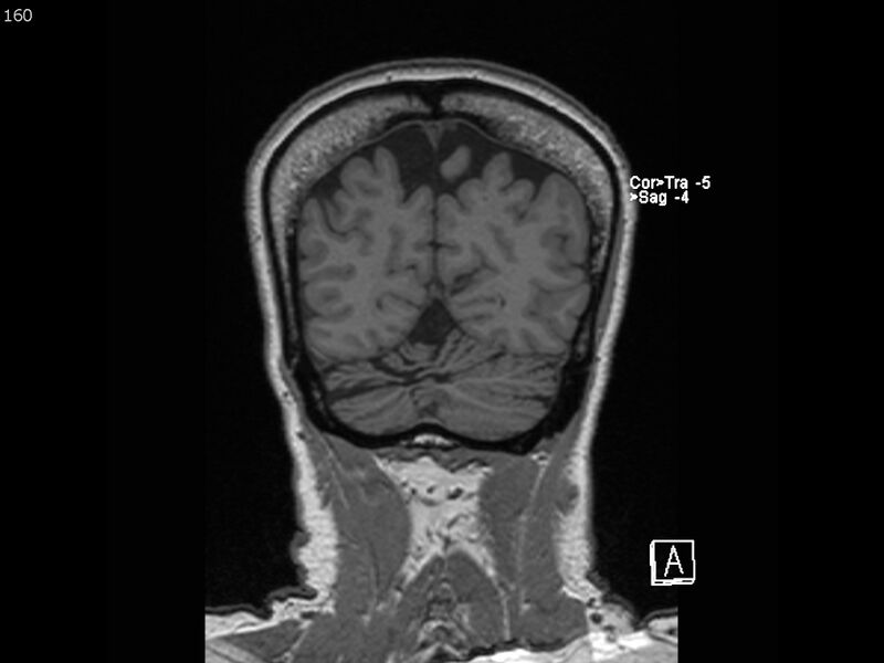 File:Atypical meningioma - intraosseous (Radiopaedia 64915-74572 Coronal T1 160).jpg