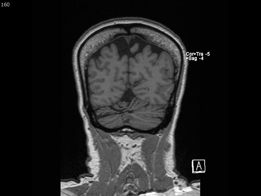 Atypical meningioma - intraosseous (Radiopaedia 64915-74572 Coronal T1 160).jpg