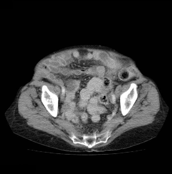 File:Autosomal dominant polycystic kidney disease (Radiopaedia 16777-16490 A 48).jpg