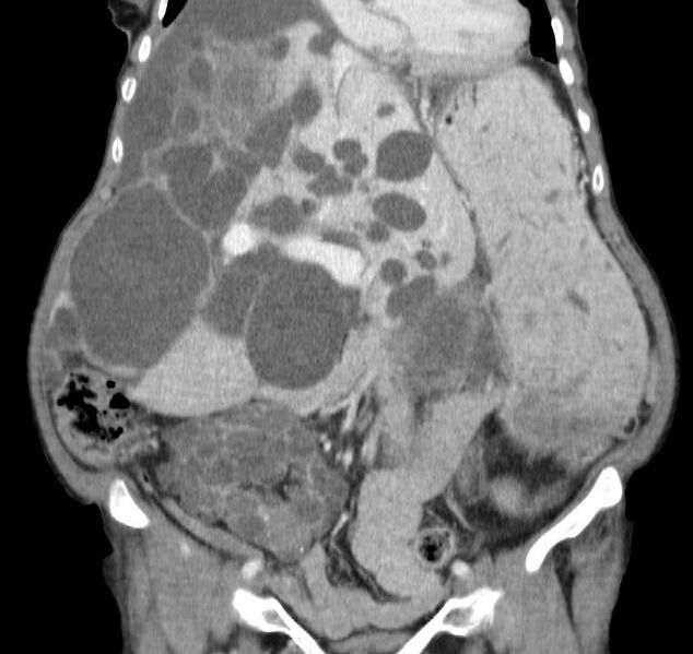 File:Autosomal dominant polycystic kidney disease (Radiopaedia 16777-16490 B 18).jpg