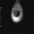 Avulsion fracture of the fibular head (Radiopaedia 74804-85808 Coronal PD fat sat 4).jpg