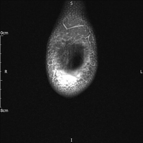 File:Avulsion fracture of the fibular head (Radiopaedia 74804-85808 Coronal PD fat sat 4).jpg