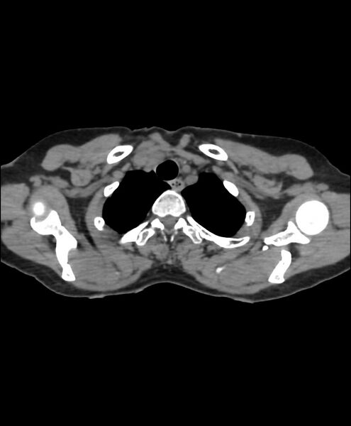 File:Azygos fissure and azygos lobe (Radiopaedia 41841-44832 Axial non-contrast 11).jpg